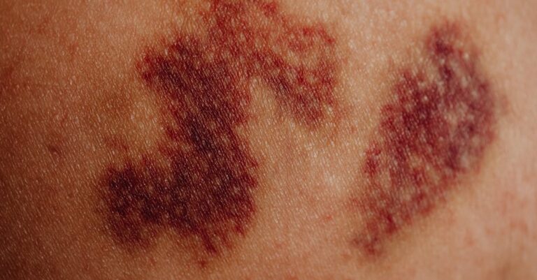 Soft tissue injury claim